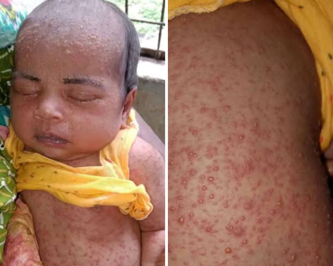 ডিমলায় হামের উপসর্গ নিয়ে নবজাতকের মৃত্যু।